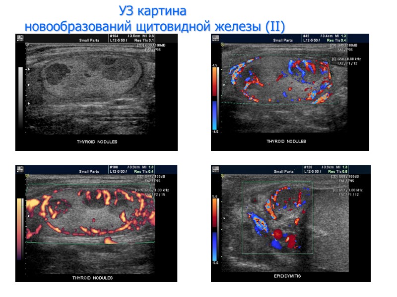УЗ картина  новообразований щитовидной железы (II)